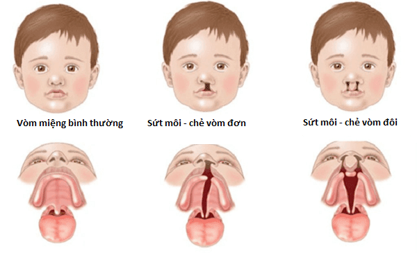 Trẻ bị sứt môi chẻ vòm phải làm sao?