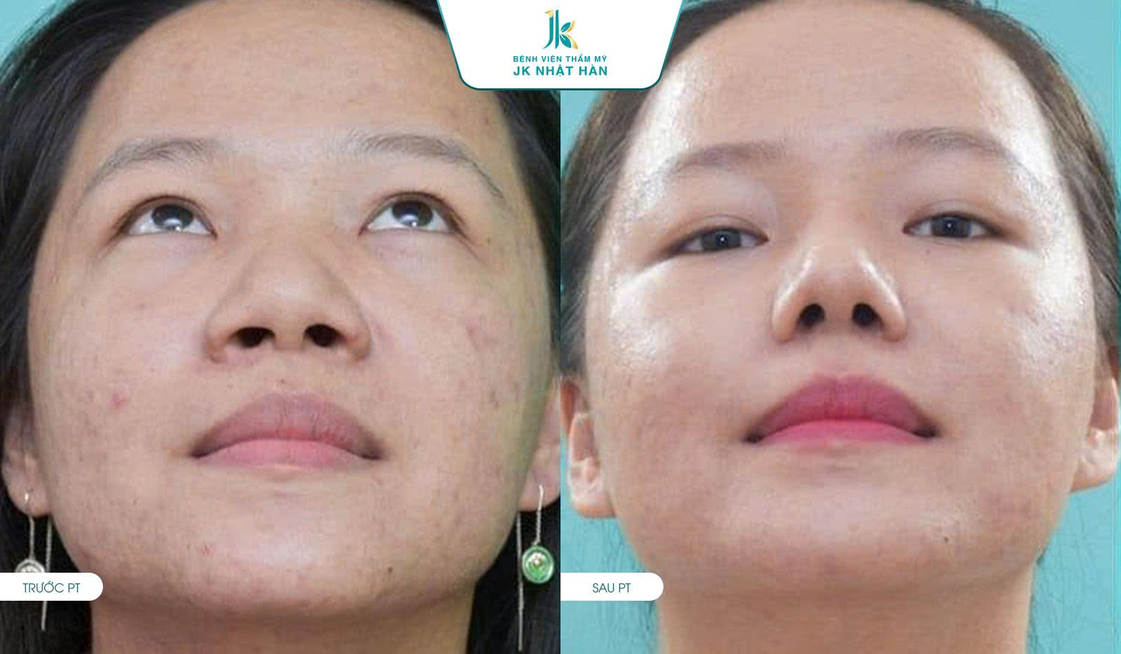 Hình ảnh trước và sau khi phẫu thuật cắt cánh mũi