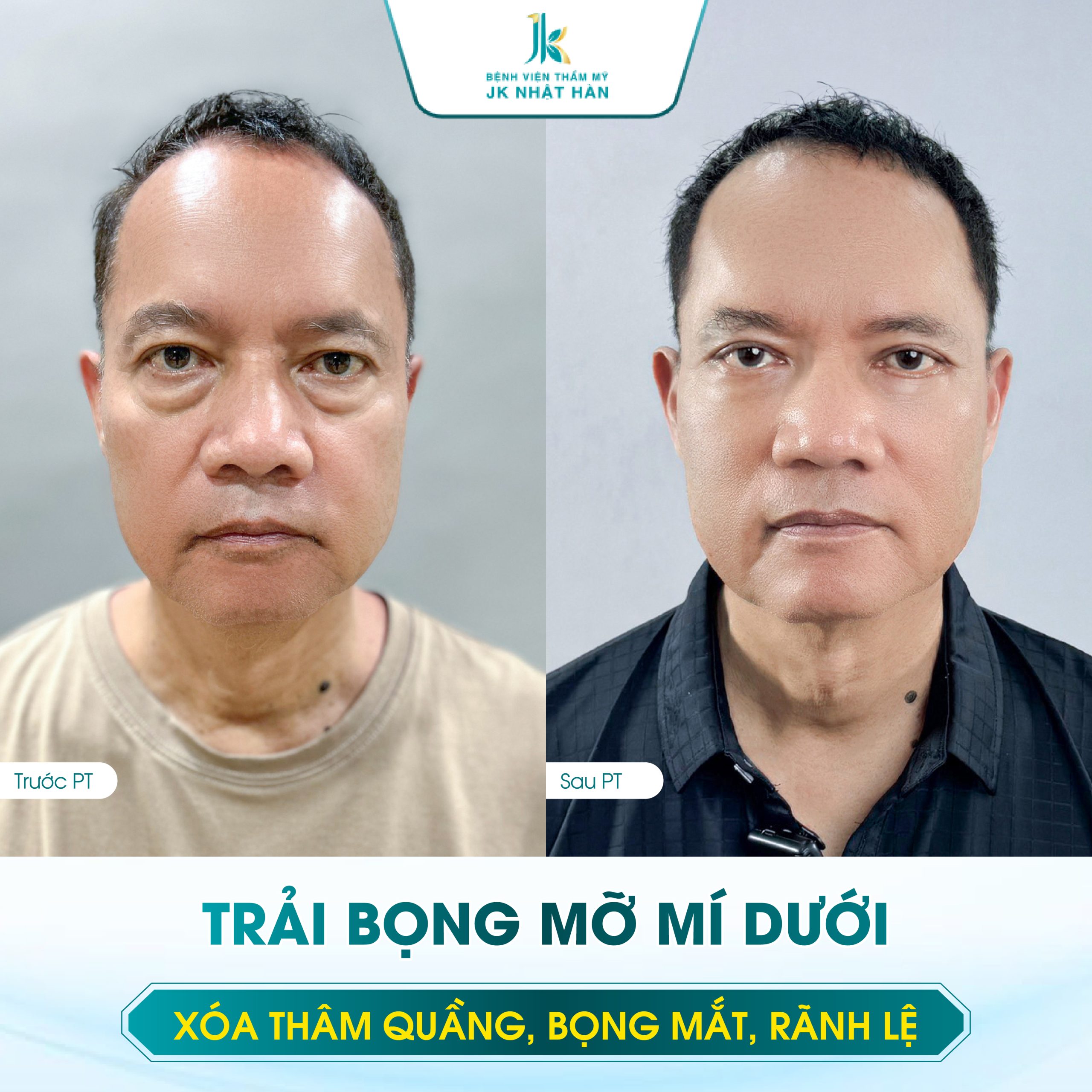 Hình ảnh trước và sau khi nam khách hàng thực hiện kỹ thuật trải bọng mỡ mí dưới tại JK Nhật Hàn