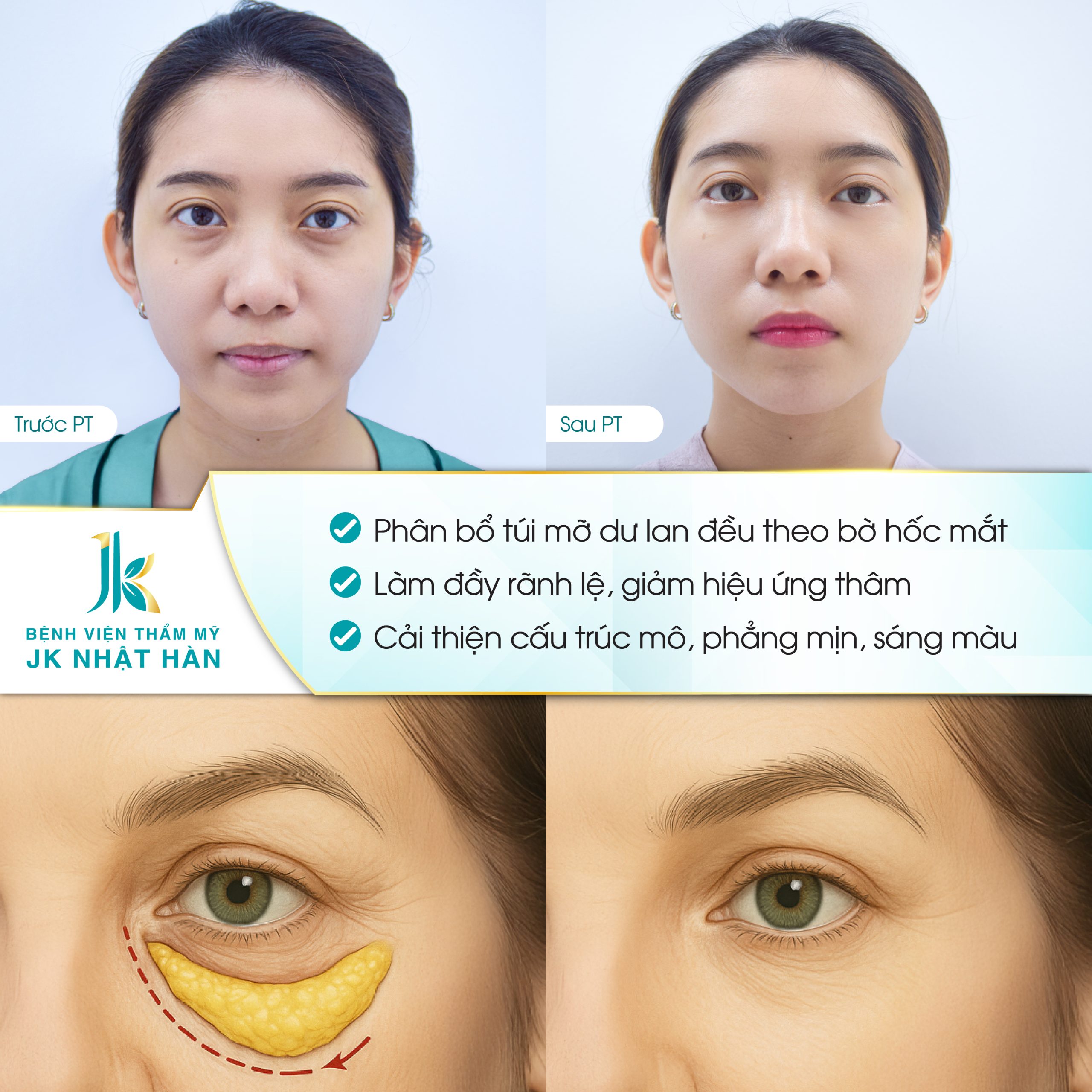 Hình ảnh trước và sau khi thực hiện trải bọng mỡ mí dưới