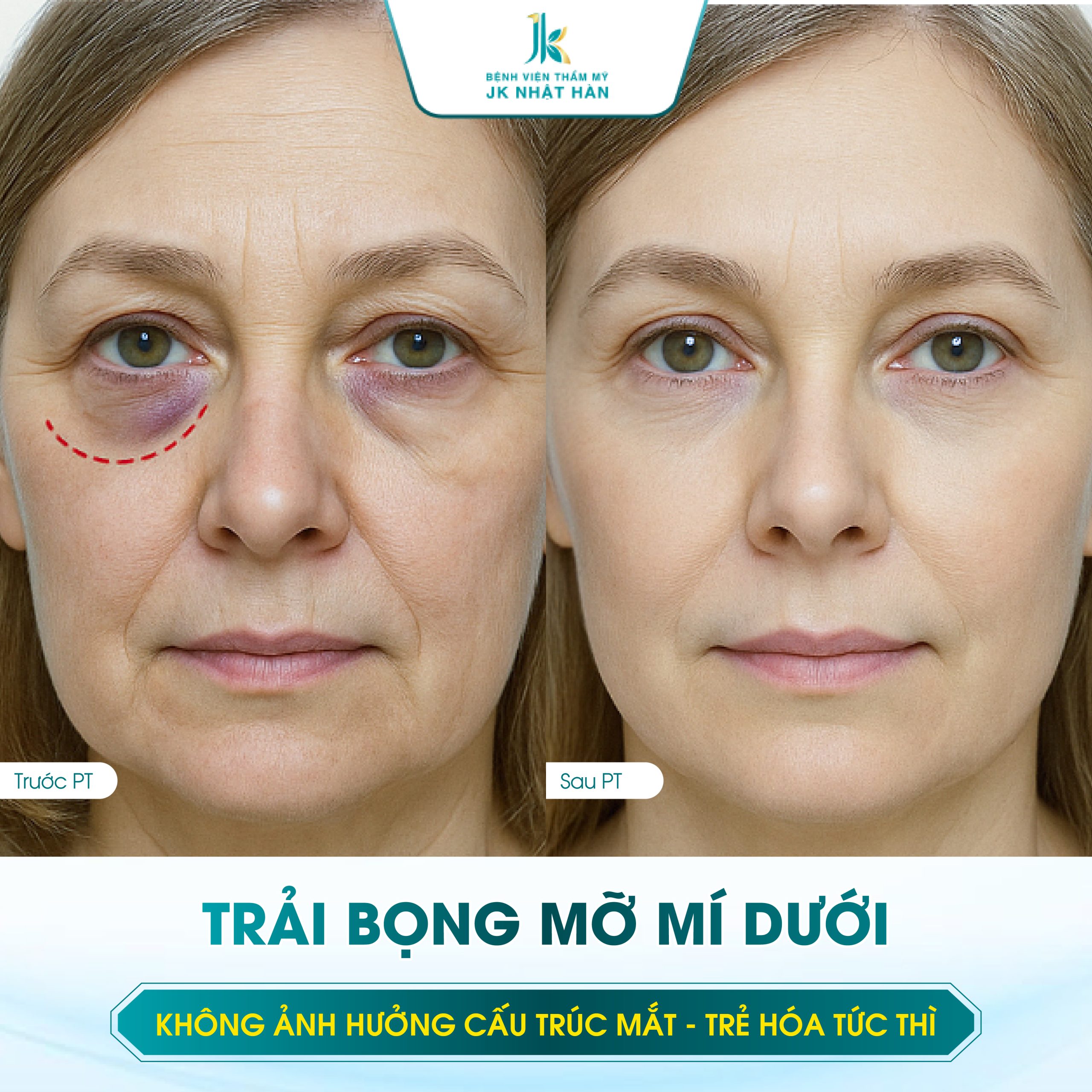 Trải bọng mỡ mí dưới giúp trẻ hóa tức thì