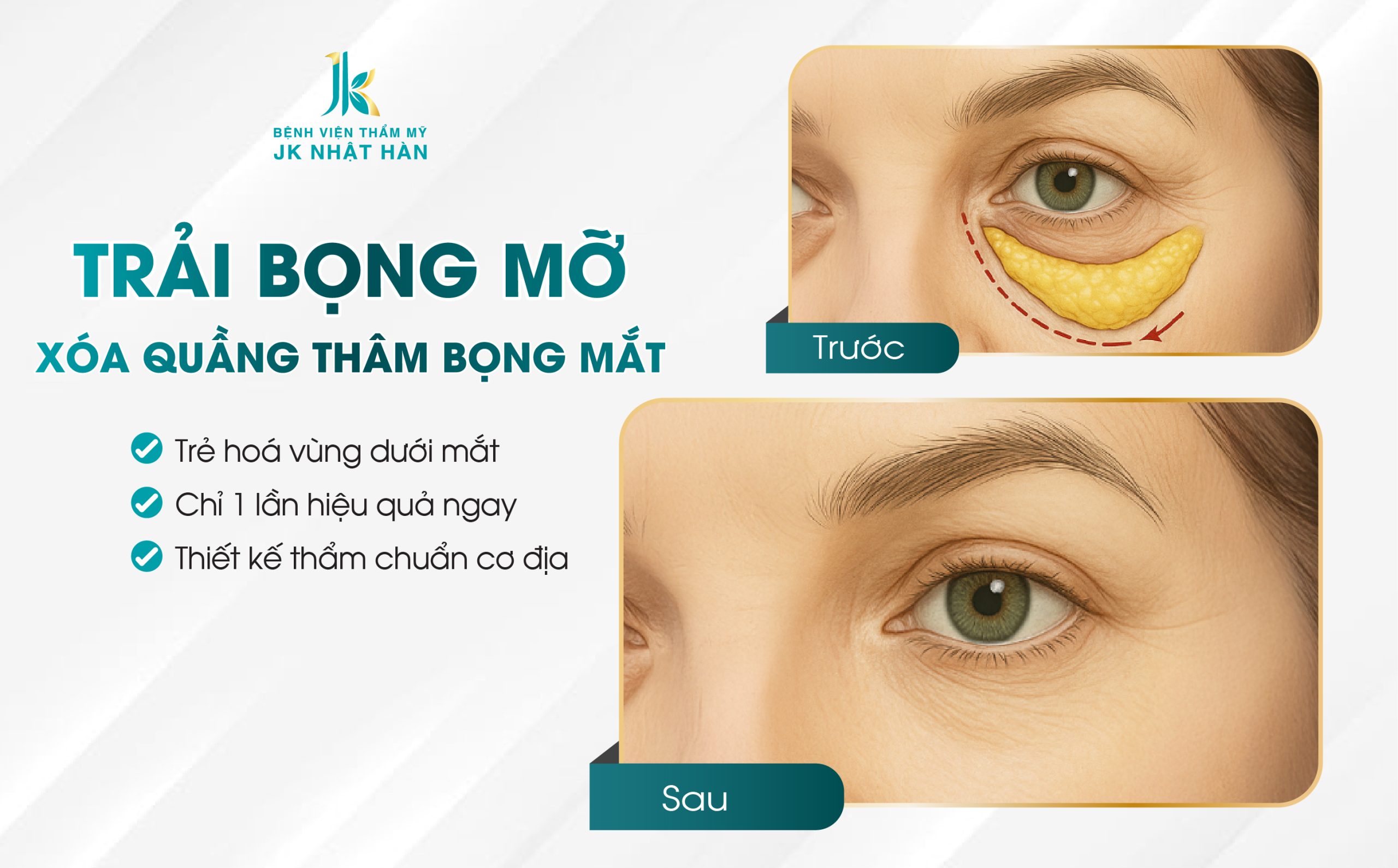 Phương pháp trải bọng mỡ - xóa thâm quầng mắt tại JK Nhật Hàn