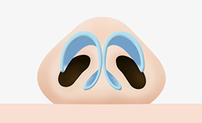 cánh mũi bị to bè sang hai bên