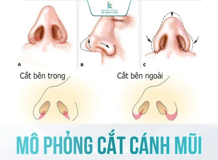 Hình ảnh mô phỏng cắt cánh mũi