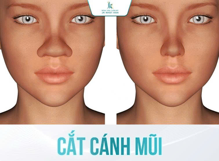 Hình ảnh mô phỏng trước và sau khi cắt cánh mũi