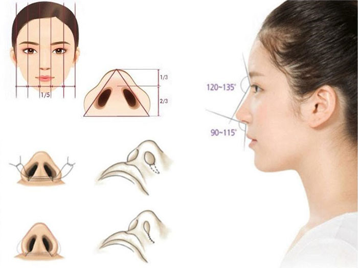 Cắt cánh mũi bao lâu hết sưng