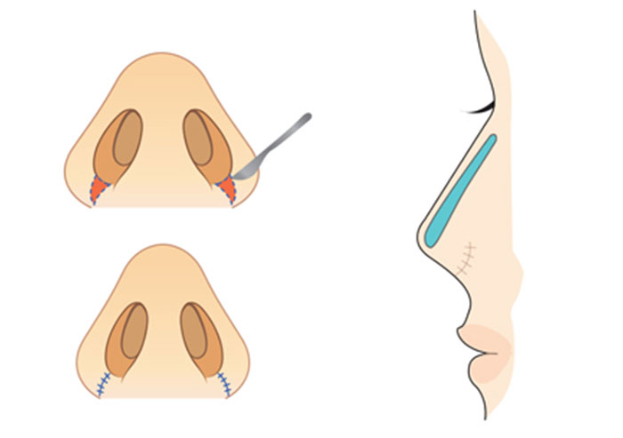 Cắt cánh mũi là gì