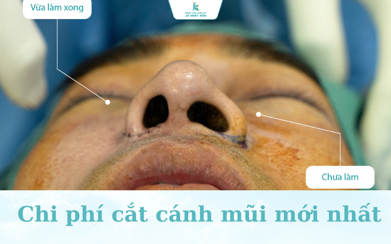 Chi phí cắt cánh mũi tại bệnh viện JK Nhật Hàn
