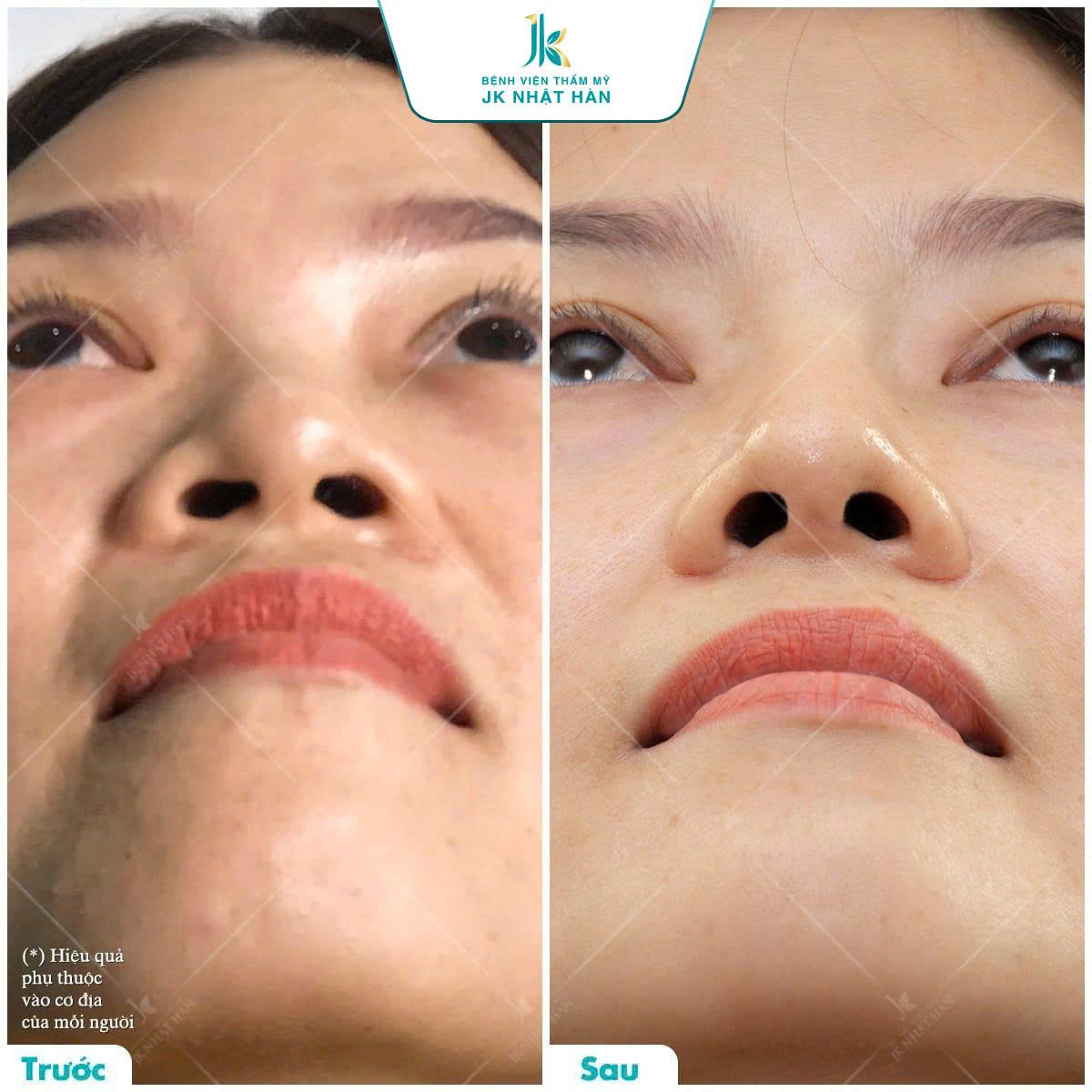 Hình ảnh trước và sau khi khách hàng thực hiện cuộn cánh mũi tại Jk Nhật Hàn