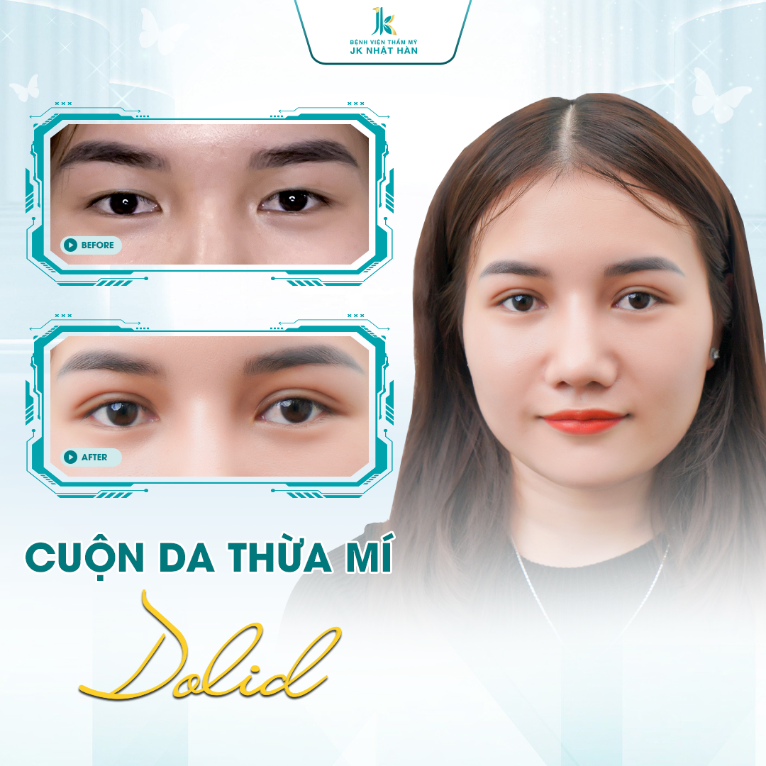 Cuộn da thừa mí Dolid