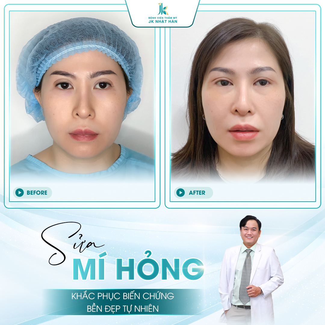 Sửa mí hỏng