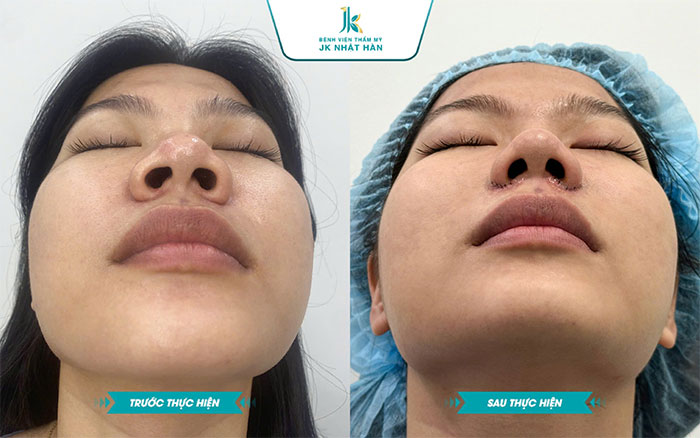 Hình ảnh trước và sau khi khách hàng thực hiện cuộn cánh mũi tại Jk Nhật Hàn