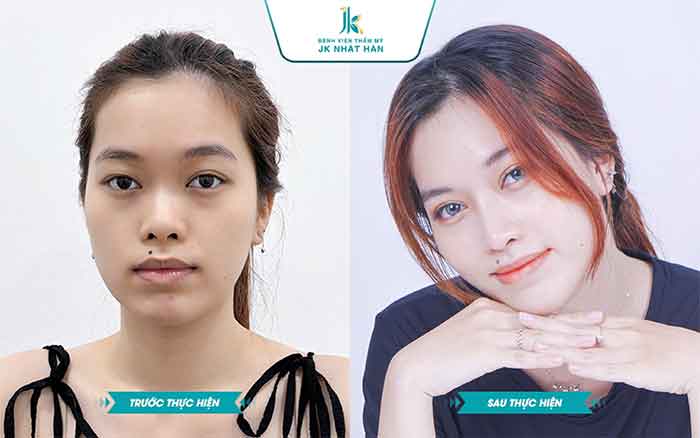 Khách hàng sau khi thực hiện chỉnh mũi tại JK Nhật Hàn