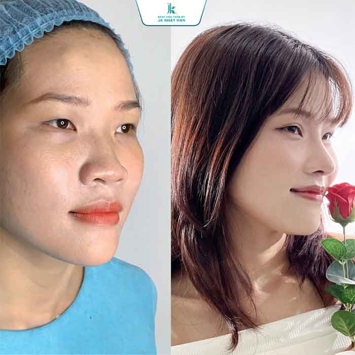 Khách hàng thực hiện cuộn cánh mũi tại JK Nhật Hàn