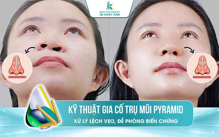 Kỹ thuật gia cố trụ vách ngăn pyramid độc quyền tài JK Nhật Hàn
