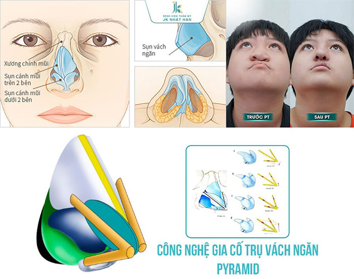 Kỹ thuật gia cố trụ vách ngăn pyramid độc quyền