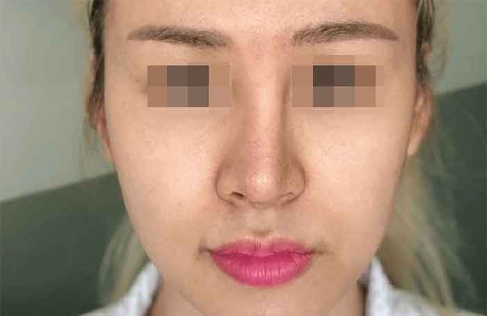 Vì sao nâng mũi bị lệch