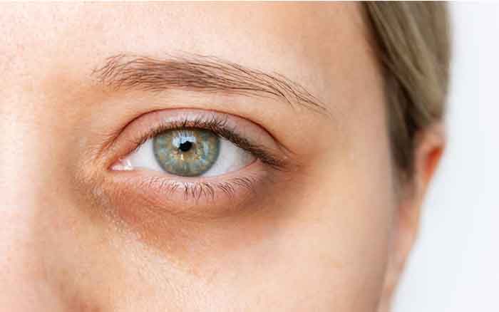 tình trạng thâm quầng mắt