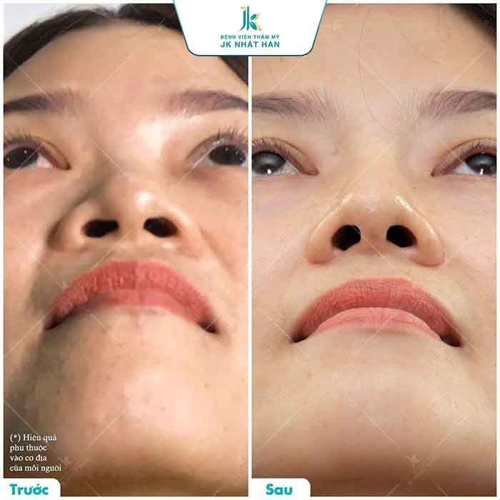 Trước và sau khi cuộn cánh mũi