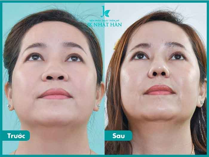 Trước và sau khi thực hiện cắt cánh mũi