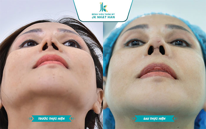 Ảnh trước và sau khi sửa lại mũi hỏng