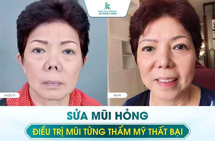 Trước và sau khi thực hiện sửa mũi hỏng tại JK Nhật Hàn