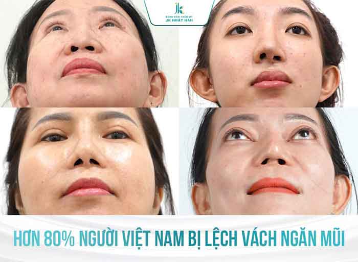Hơn 80% người Việt bị lệch vách ngăn mũi