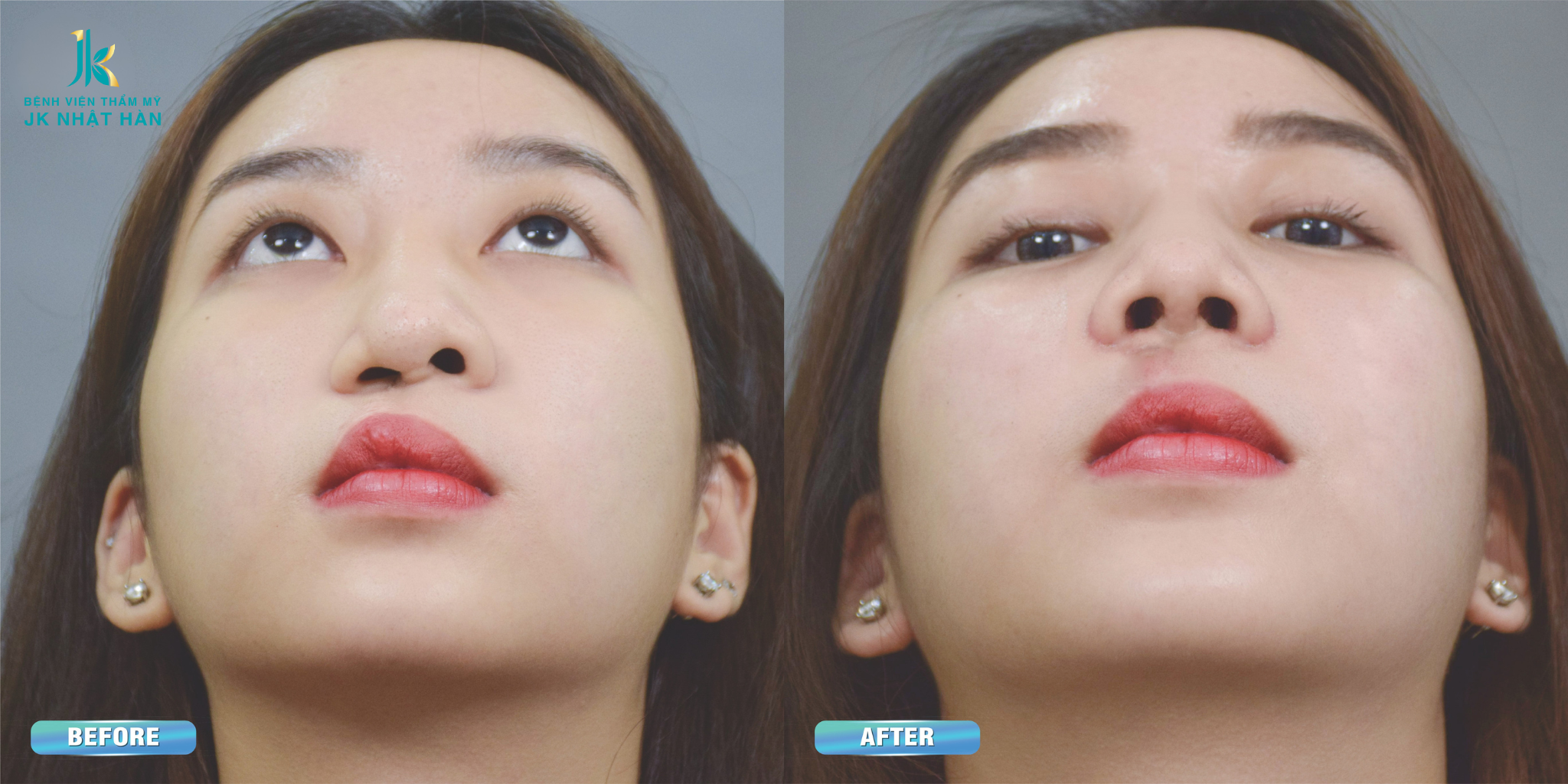 Trước và sau khi chữa vẹo vách ngăn mũi