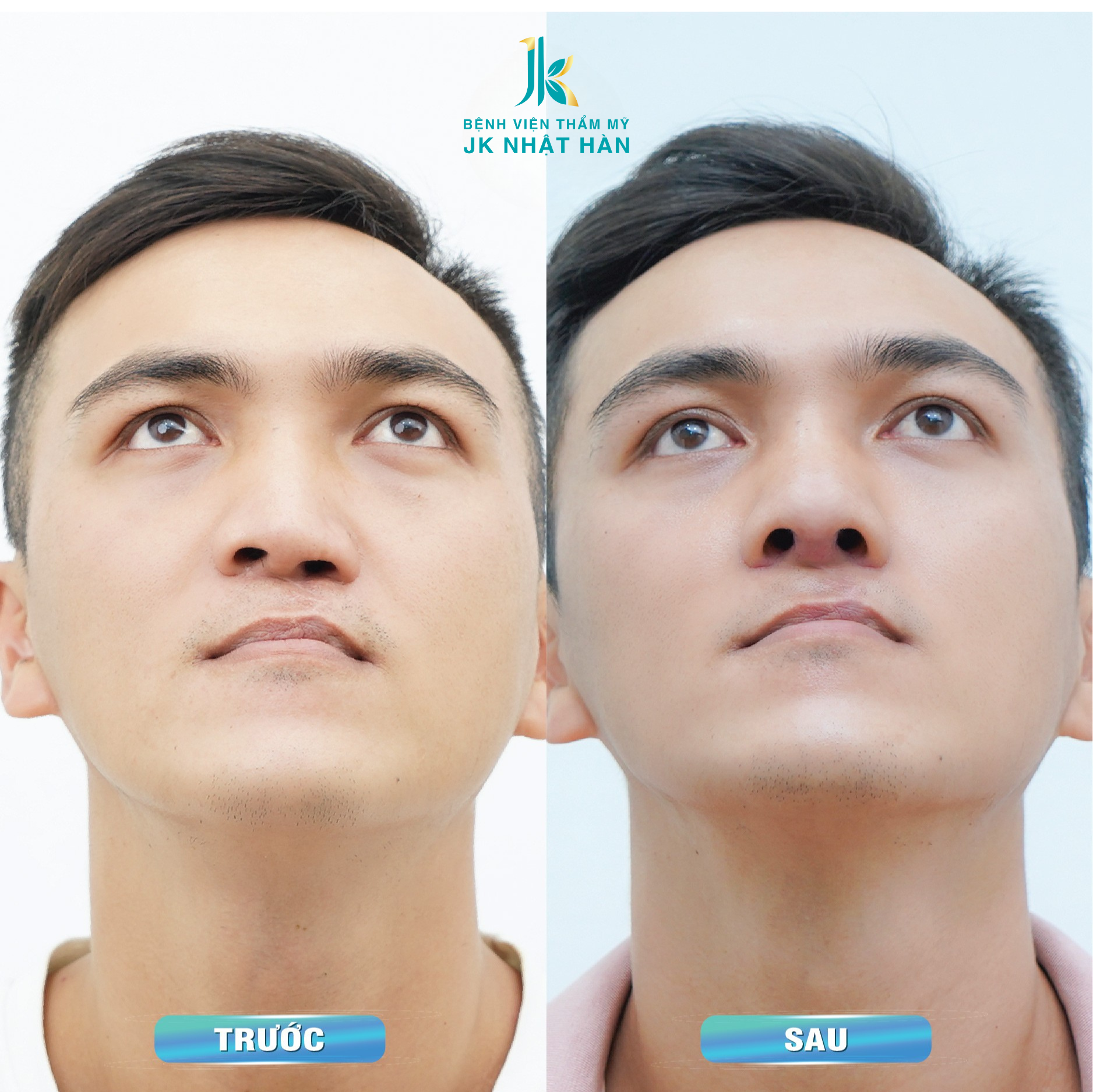 Trước và sau khi chữa vẹo vách ngăn mũi