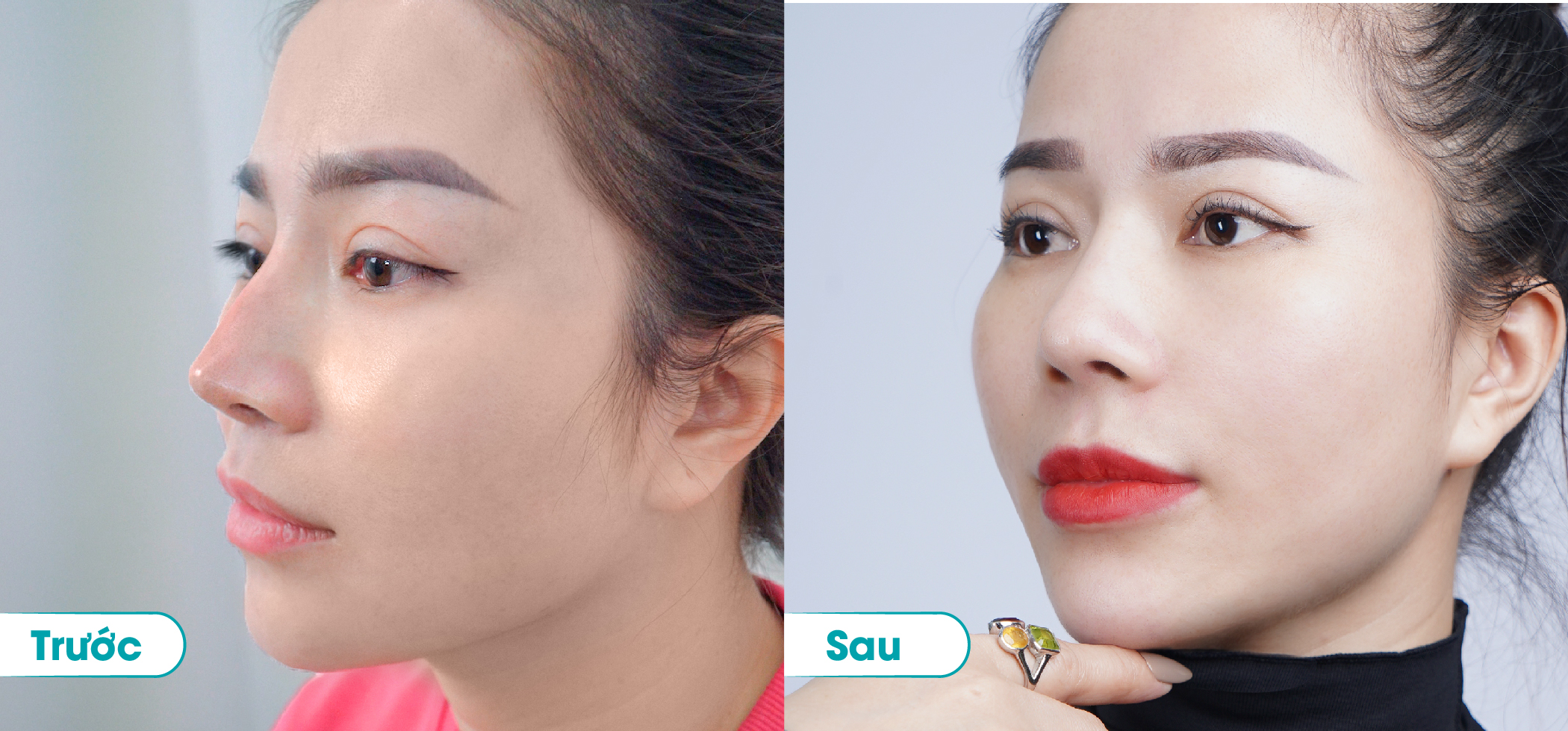 Ảnh trước và sau khi xử tính tình trạng mũi bóng đỏ