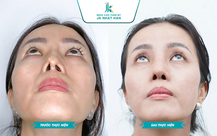 Ảnh trước và sau khi phẫu thuật mổ lệch vách ngăn mũi