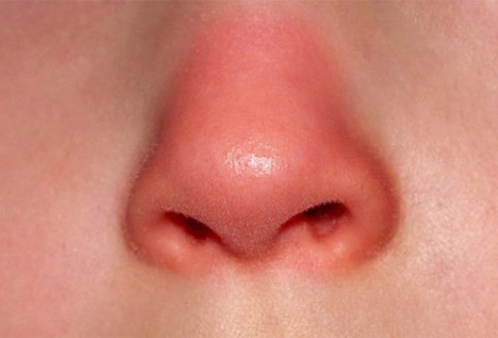 Mũi bỏng đỏ sau khi nâng
