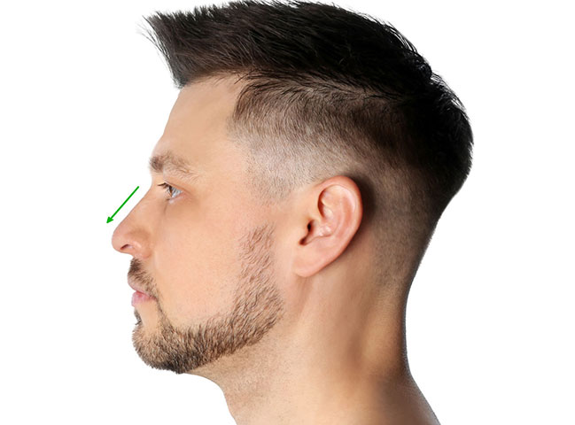 Phẫu thuật cắt cánh mũi cho nam giới