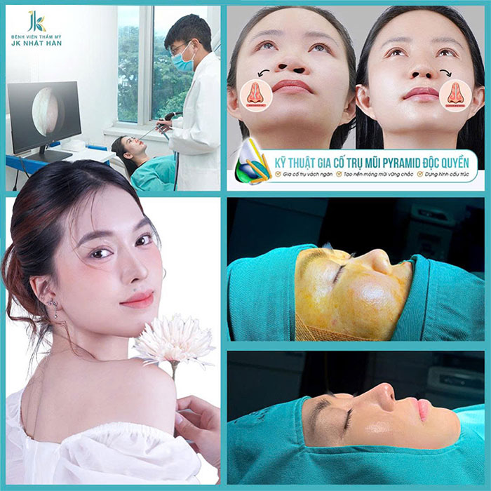 Kỹ thuật piramid kết hợp với nâng mũi cấu trúc jko