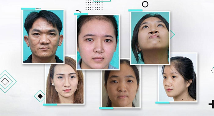 Một số trường hợp mũi biến dạng