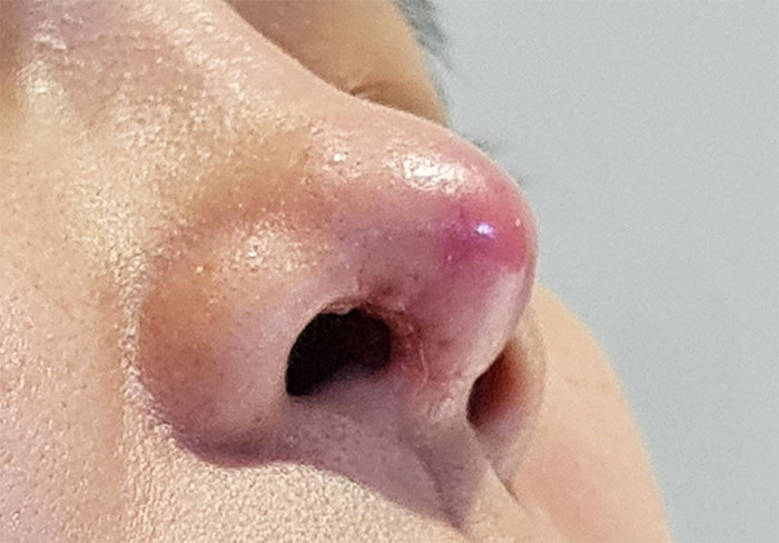 Mũi bị bóng đỏ