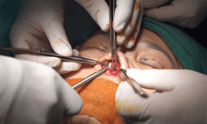 Phẩu thuật chỉnh hình vách ngăn mũi