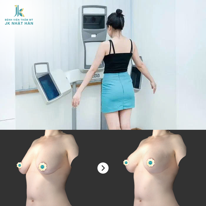 6 bước quy trình thực hiện treo ngực sa trễ nội soi chuẩn Y khoa