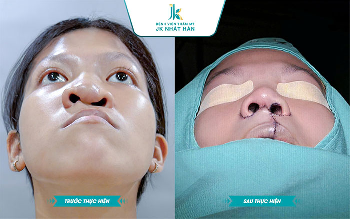 chi phí mổ lệch vách ngăn mũi