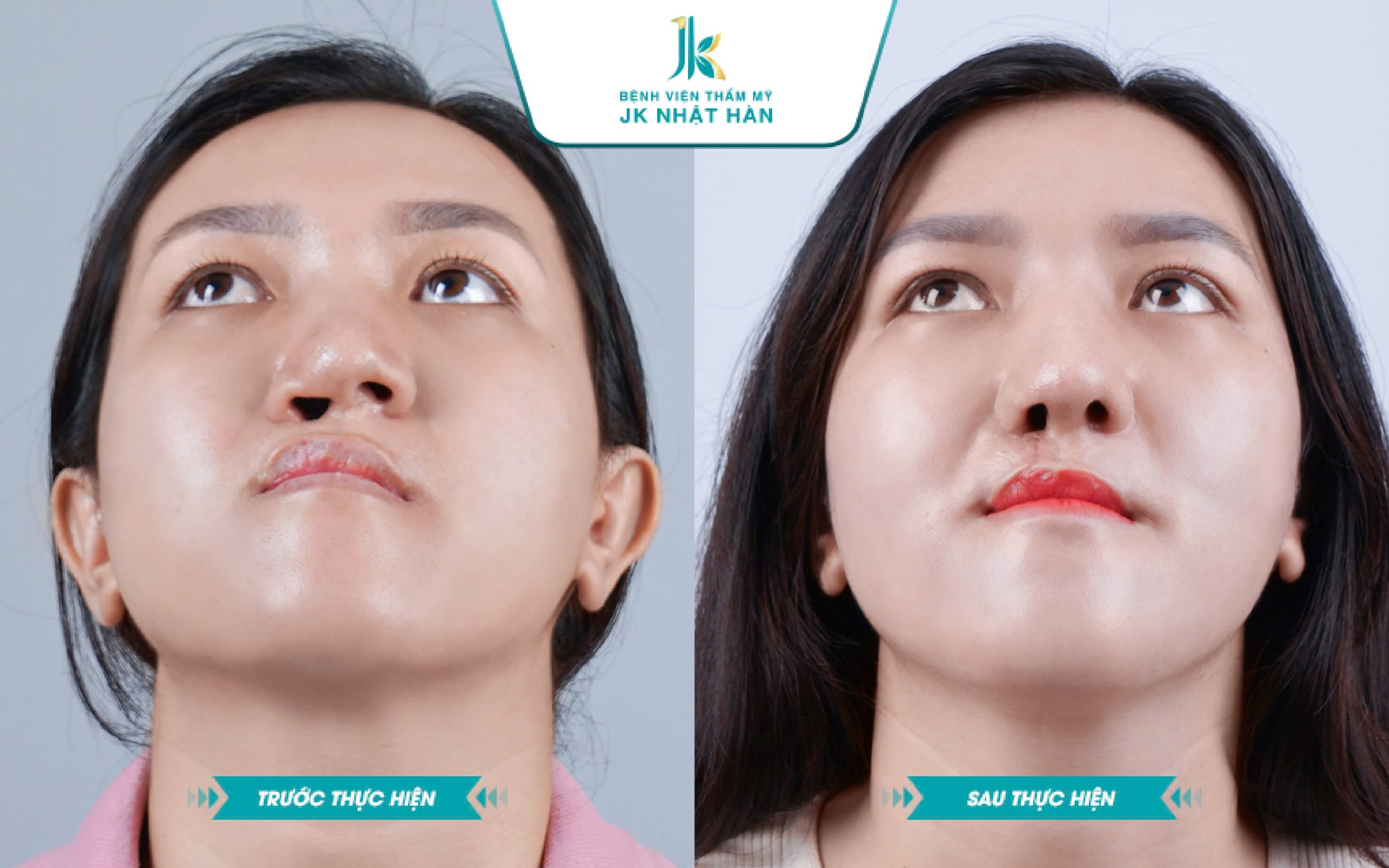 Ảnh trước và sau khi thực hiện sửa mũi bị lệch