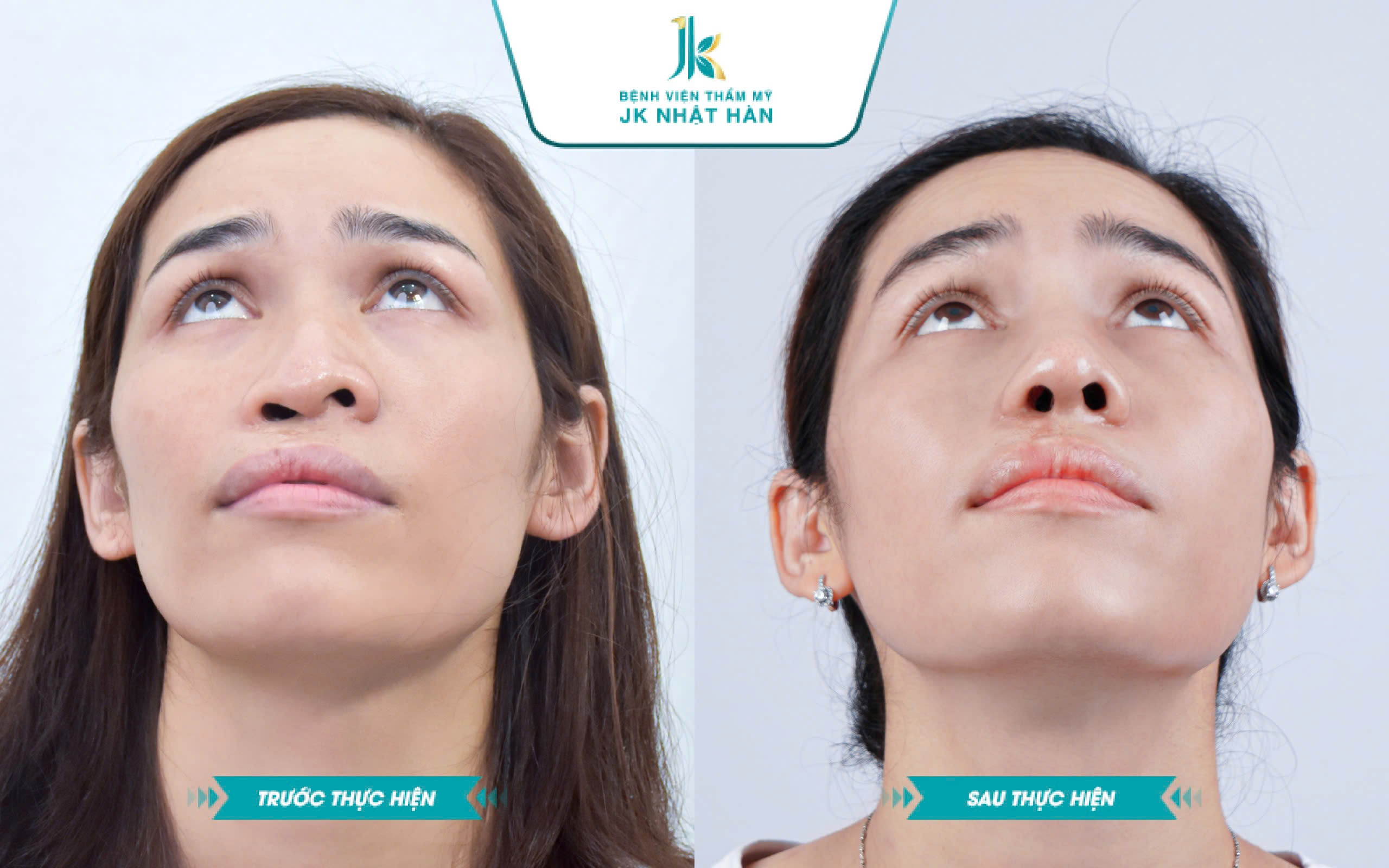 Trước và sau khi mổ lệch vách ngăn mũi