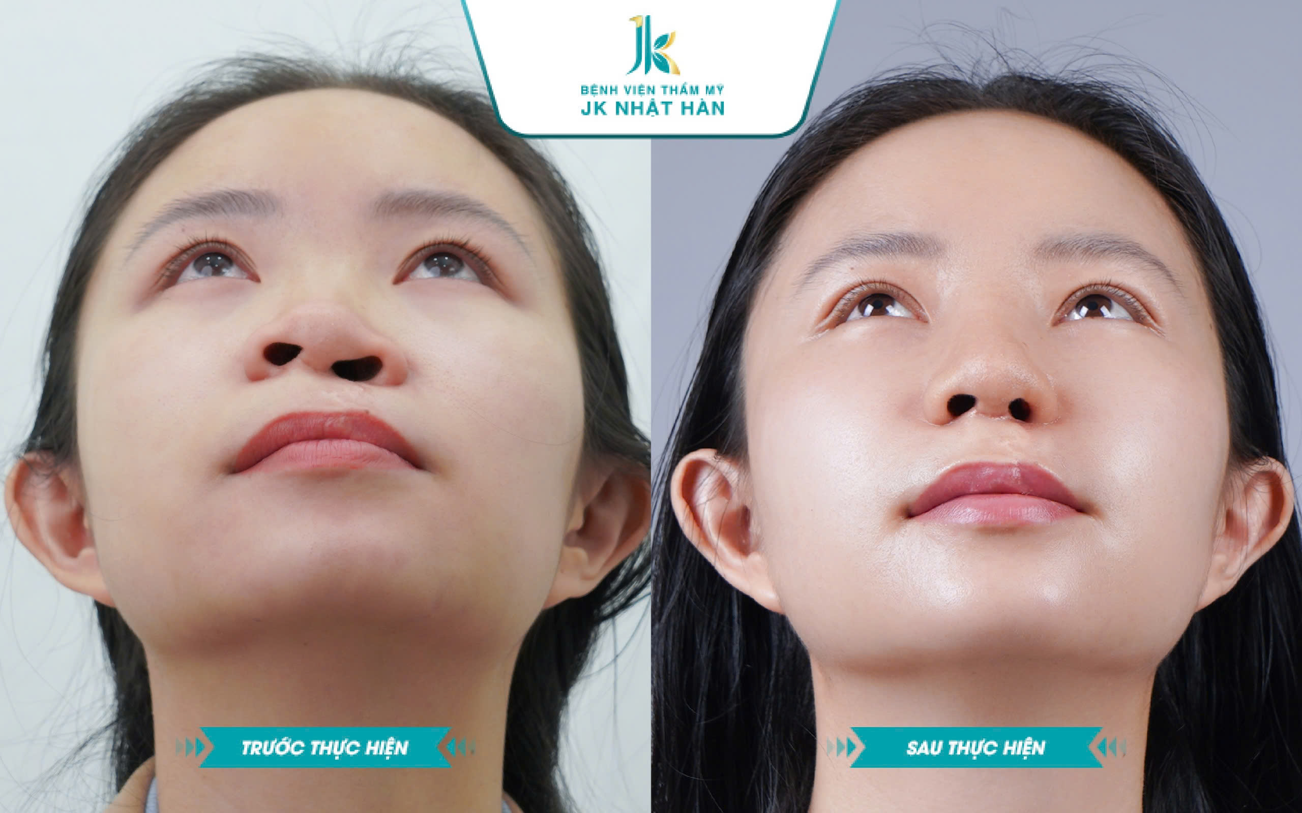 Trước và sau khi mổ lệch vách ngăn mũi