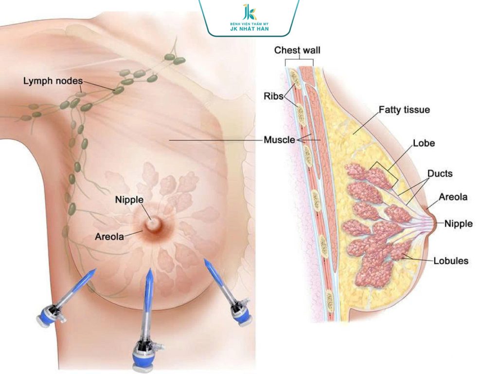 6 bước quy trình thực hiện treo ngực sa trễ nội soi chuẩn Y khoa