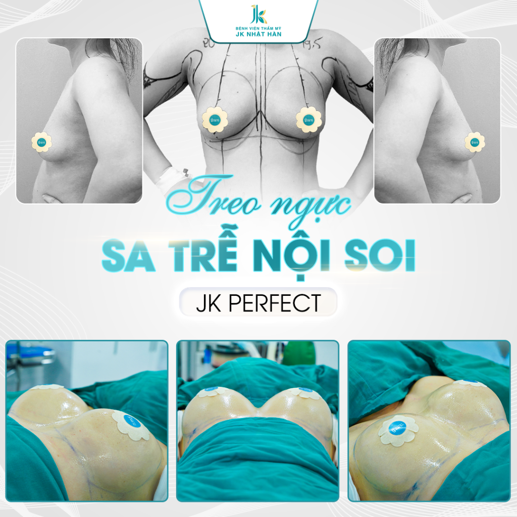 Treo ngực sa trễ nội soi khác gì phương pháp treo ngực kẹo mút?