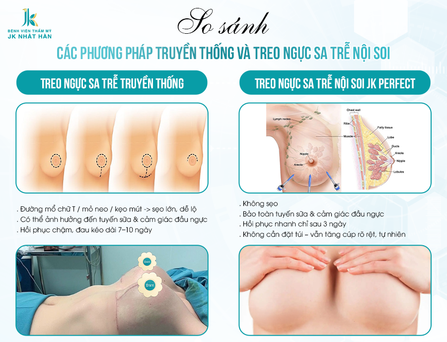 So sánh ưu nhược điểm của treo ngực sa trễ nội soi với treo ngực sa trễ truyền thống
