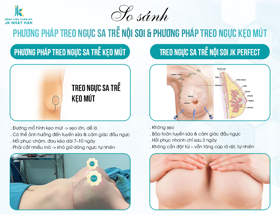 Bảng so sánh – Treo ngực sa trễ nội soi khác gì phương pháp treo ngực kẹo mút?