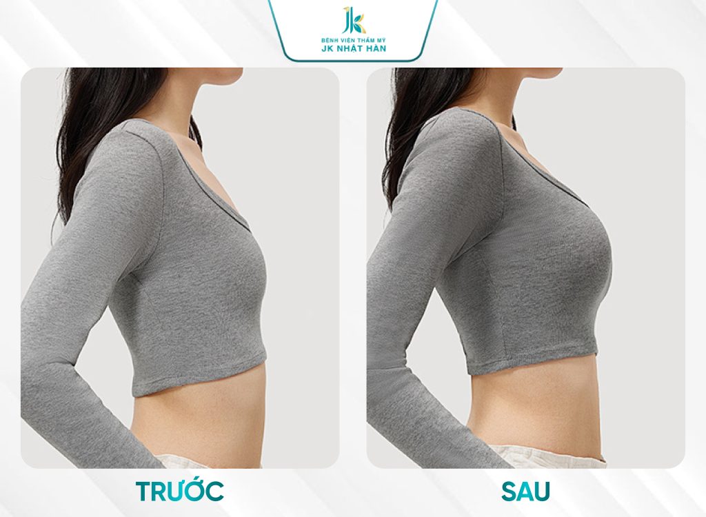 Hình ảnh trước và sau khi treo ngực sa trễ nội soi