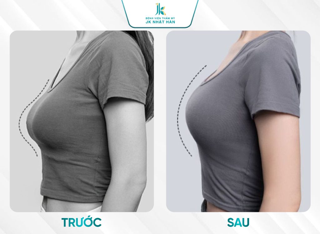 Khách hàng thực tế Treo ngực sa trễ nội soi bác sĩ Trí
