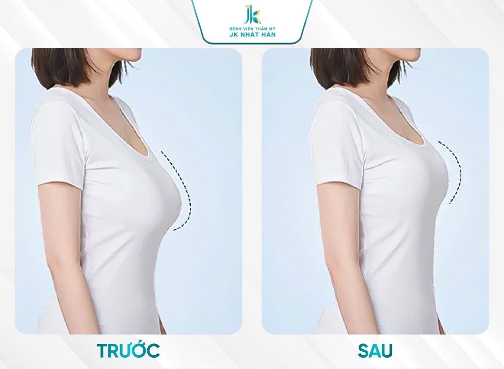 Ảnh trước-sau treo ngực sa trễ nội soi JK Perfect