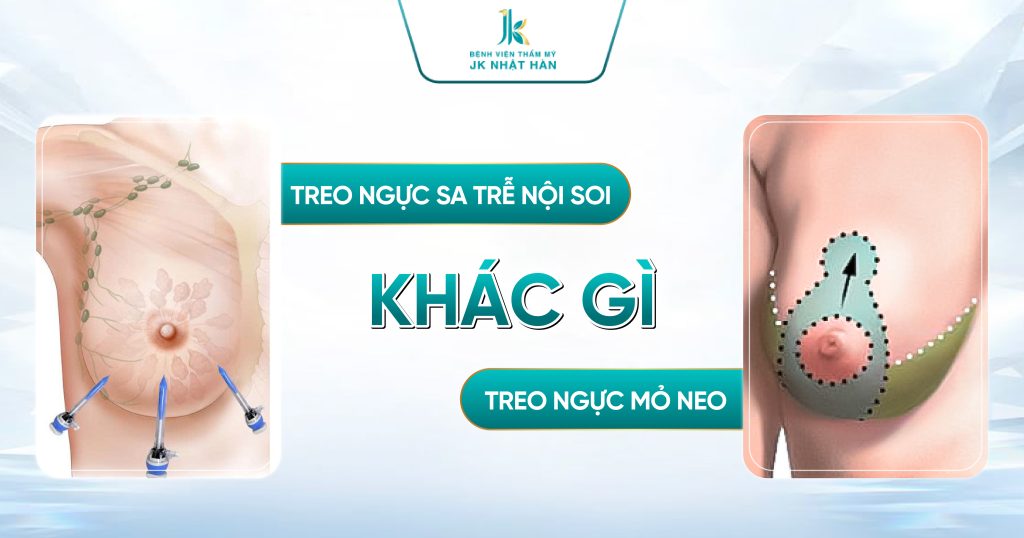 Treo ngực sa trễ nội soi khác gì phương pháp treo ngực mỏ neo? So sánh chi tiết